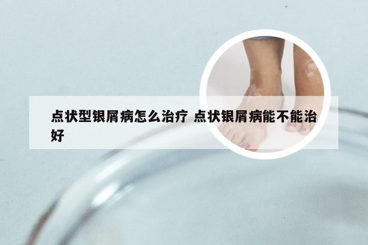 点状型银屑病怎么治疗 点状银屑病能不能治好