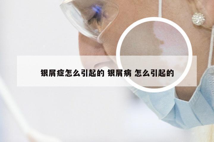 银屑症怎么引起的 银屑病 怎么引起的