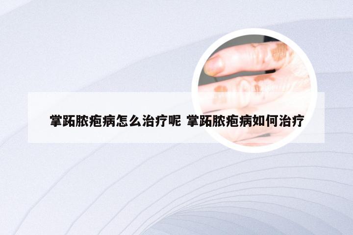 掌跖脓疱病怎么治疗呢 掌跖脓疱病如何治疗