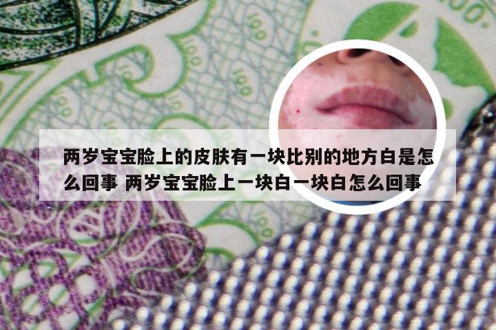 两岁宝宝脸上的皮肤有一块比别的地方白是怎么回事 两岁宝宝脸上一块白一块白怎么回事