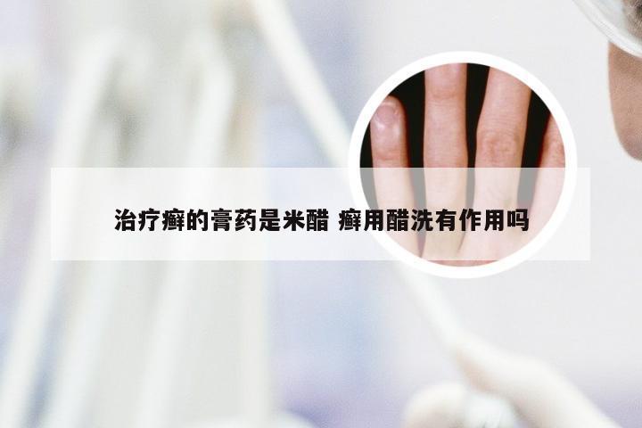 治疗癣的膏药是米醋 癣用醋洗有作用吗