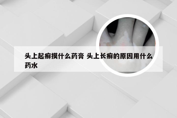 头上起癣摸什么药膏 头上长癣的原因用什么药水