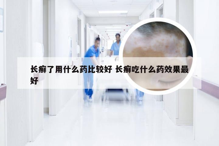 长癣了用什么药比较好 长癣吃什么药效果最好