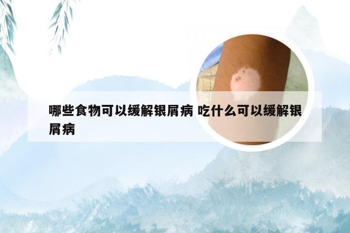 哪些食物可以缓解银屑病 吃什么可以缓解银屑病