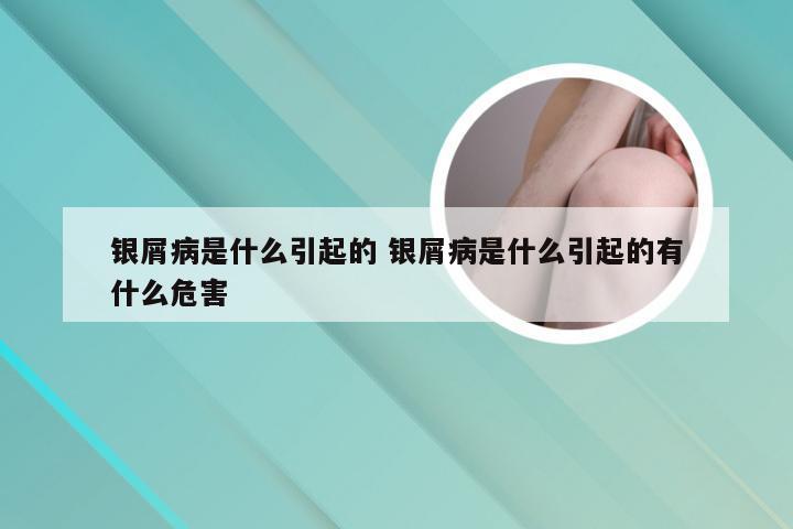 银屑病是什么引起的 银屑病是什么引起的有什么危害
