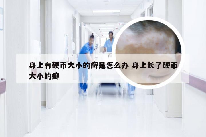 身上有硬币大小的癣是怎么办 身上长了硬币大小的癣
