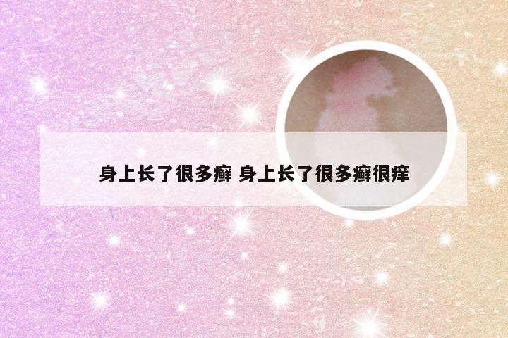 身上长了很多癣 身上长了很多癣很痒