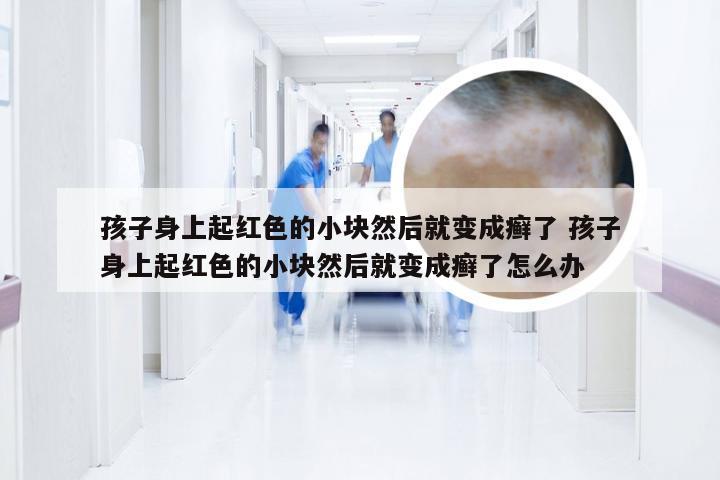 孩子身上起红色的小块然后就变成癣了 孩子身上起红色的小块然后就变成癣了怎么办