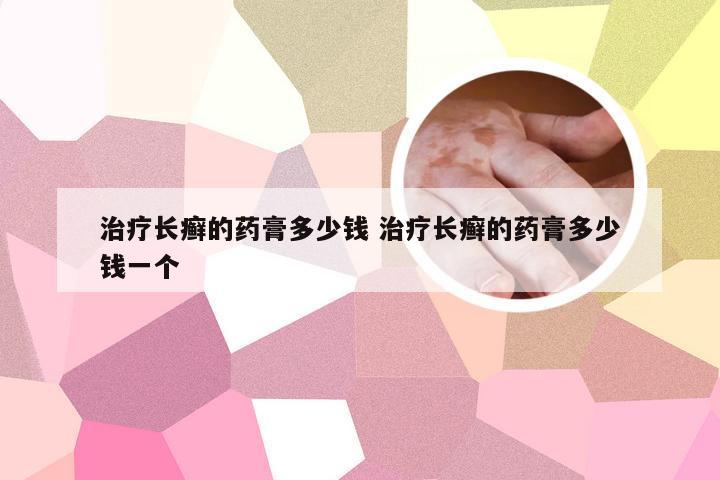 治疗长癣的药膏多少钱 治疗长癣的药膏多少钱一个