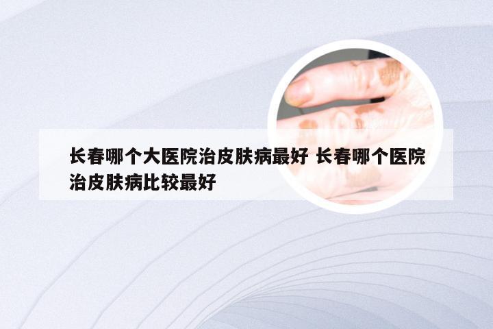 长春哪个大医院治皮肤病最好 长春哪个医院治皮肤病比较最好