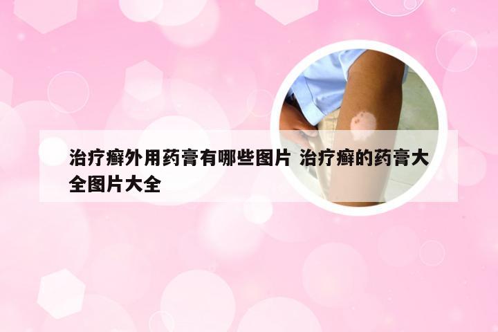 治疗癣外用药膏有哪些图片 治疗癣的药膏大全图片大全
