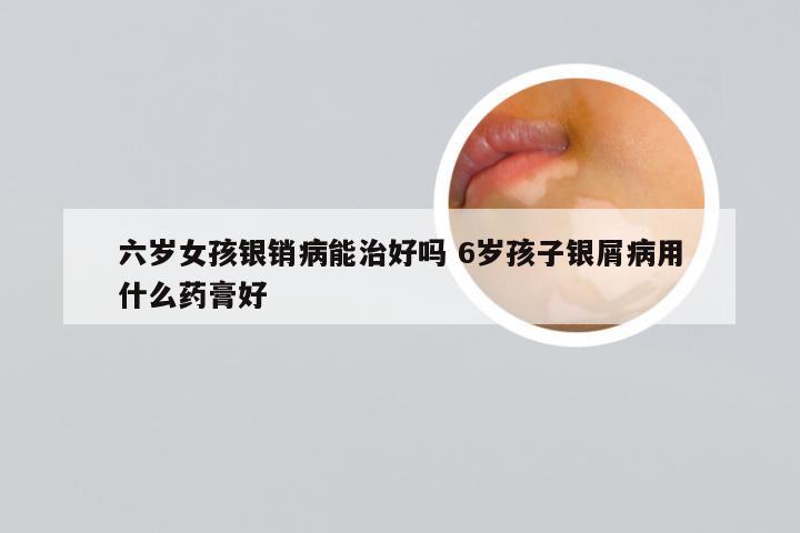 六岁女孩银销病能治好吗 6岁孩子银屑病用什么药膏好