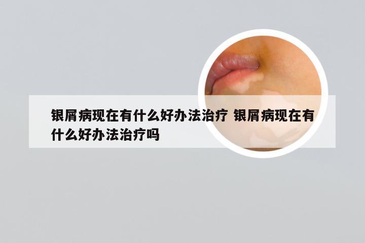 银屑病现在有什么好办法治疗 银屑病现在有什么好办法治疗吗