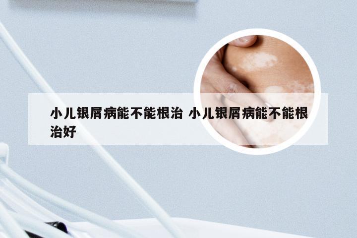 小儿银屑病能不能根治 小儿银屑病能不能根治好