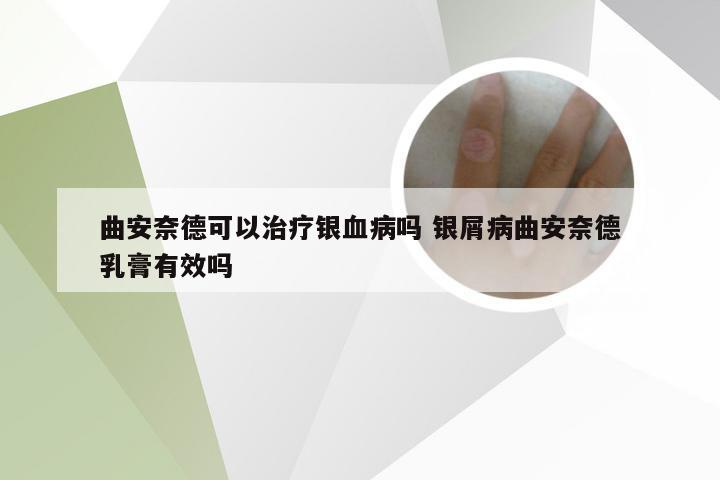 曲安奈德可以治疗银血病吗 银屑病曲安奈德乳膏有效吗