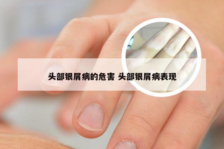头部银屑病的危害 头部银屑病表现