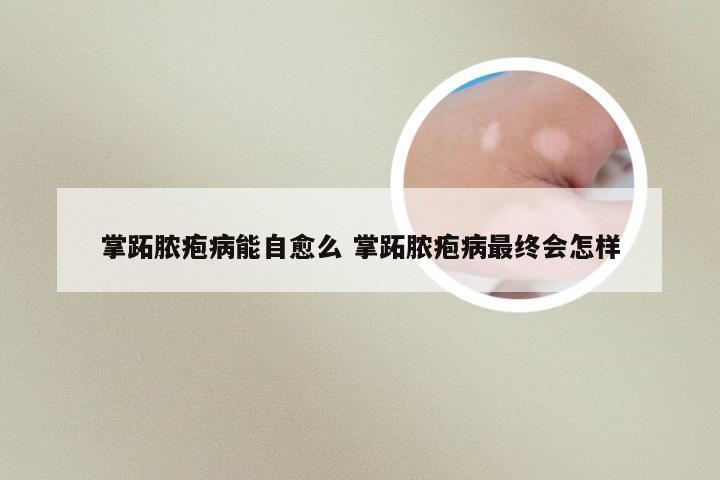 掌跖脓疱病能自愈么 掌跖脓疱病最终会怎样