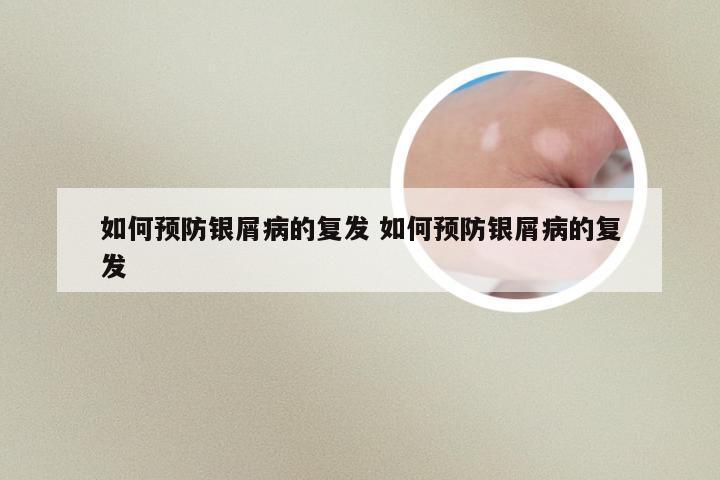 如何预防银屑病的复发 如何预防银屑病的复发