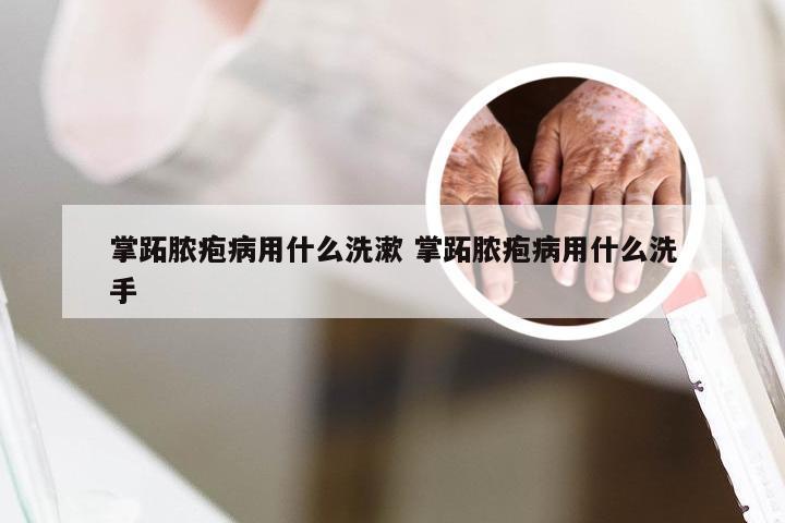 掌跖脓疱病用什么洗漱 掌跖脓疱病用什么洗手