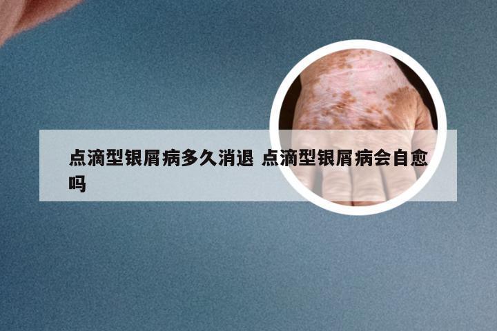 点滴型银屑病多久消退 点滴型银屑病会自愈吗