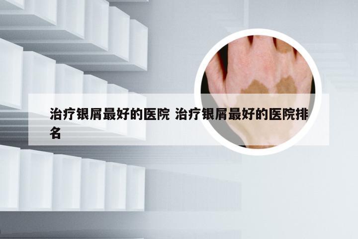 治疗银屑最好的医院 治疗银屑最好的医院排名