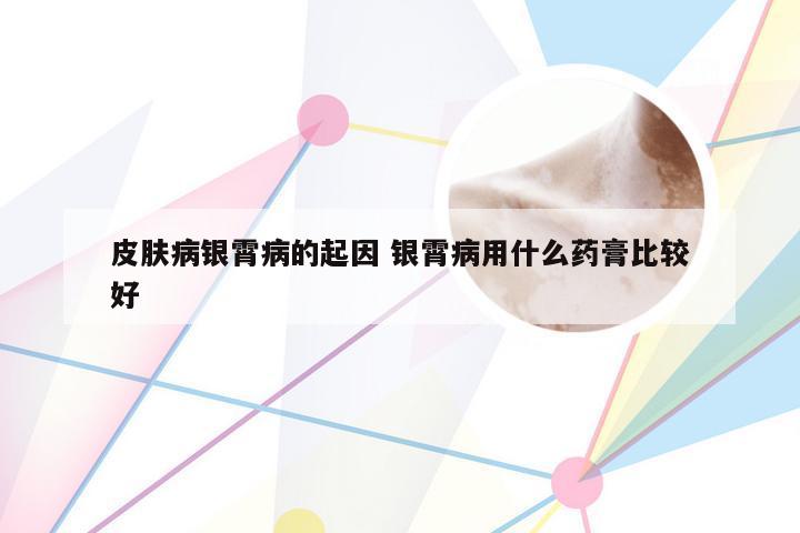皮肤病银霄病的起因 银霄病用什么药膏比较好