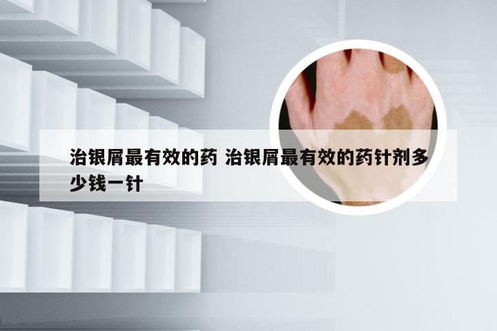 治银屑最有效的药 治银屑最有效的药针剂多少钱一针