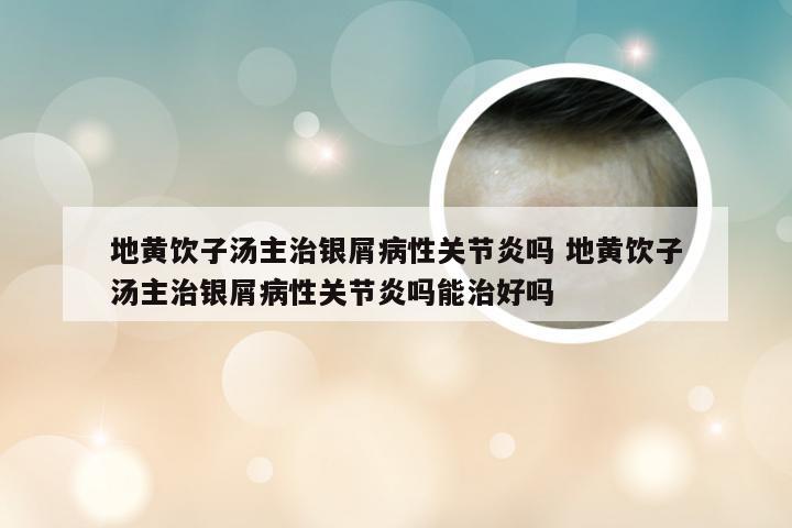 地黄饮子汤主治银屑病性关节炎吗 地黄饮子汤主治银屑病性关节炎吗能治好吗