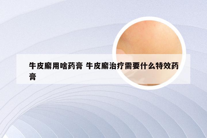 牛皮廨用啥药膏 牛皮廨治疗需要什么特效药膏