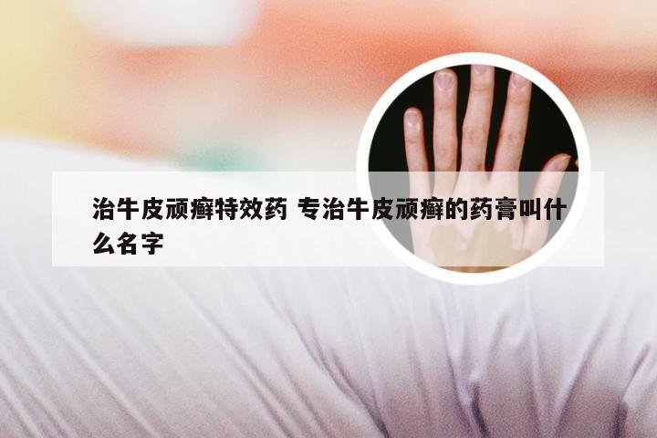 治牛皮顽癣特效药 专治牛皮顽癣的药膏叫什么名字
