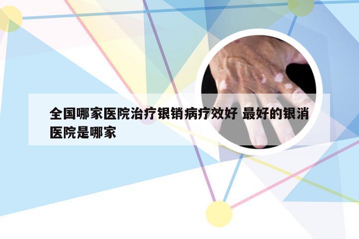 全国哪家医院治疗银销病疗效好 最好的银消医院是哪家