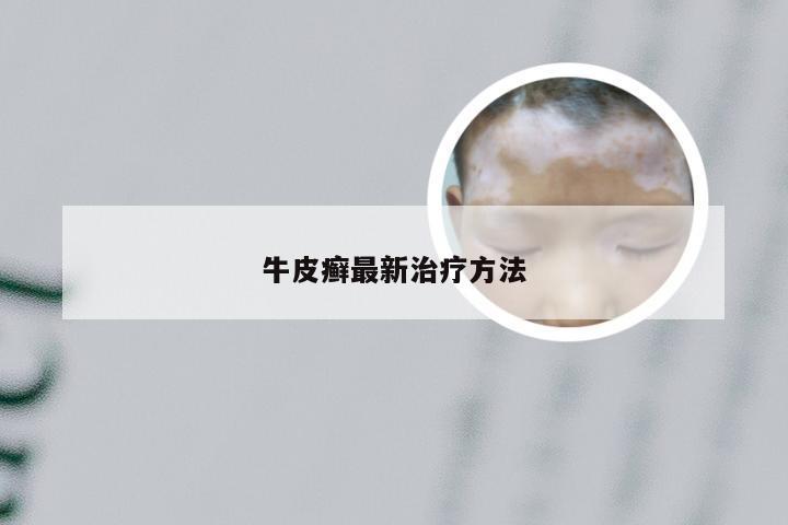 牛皮癣最新治疗方法