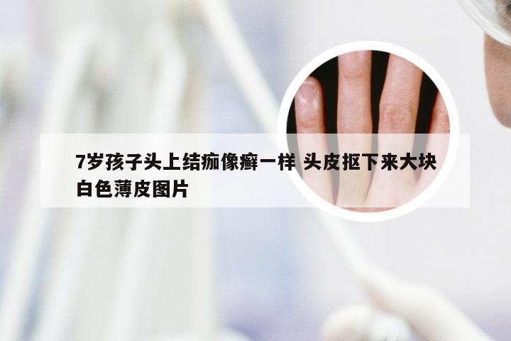 7岁孩子头上结痂像癣一样 头皮抠下来大块白色薄皮图片