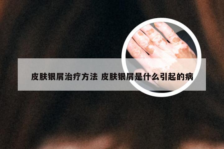 皮肤银屑治疗方法 皮肤银屑是什么引起的病