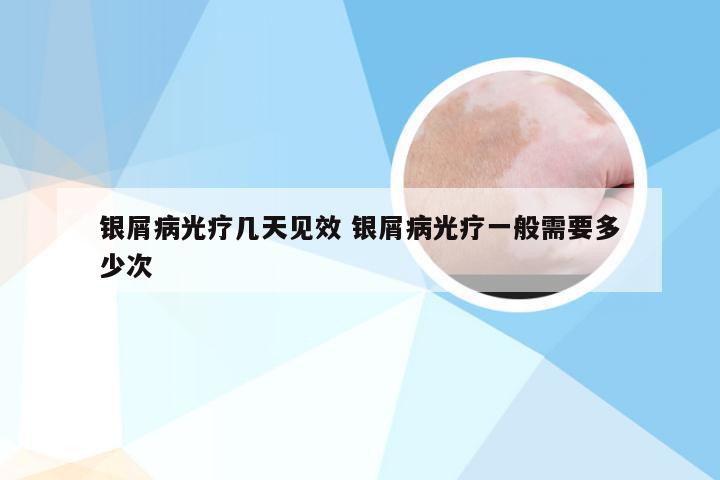 银屑病光疗几天见效 银屑病光疗一般需要多少次