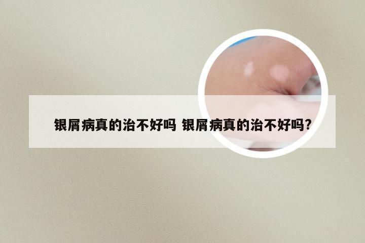 银屑病真的治不好吗 银屑病真的治不好吗?