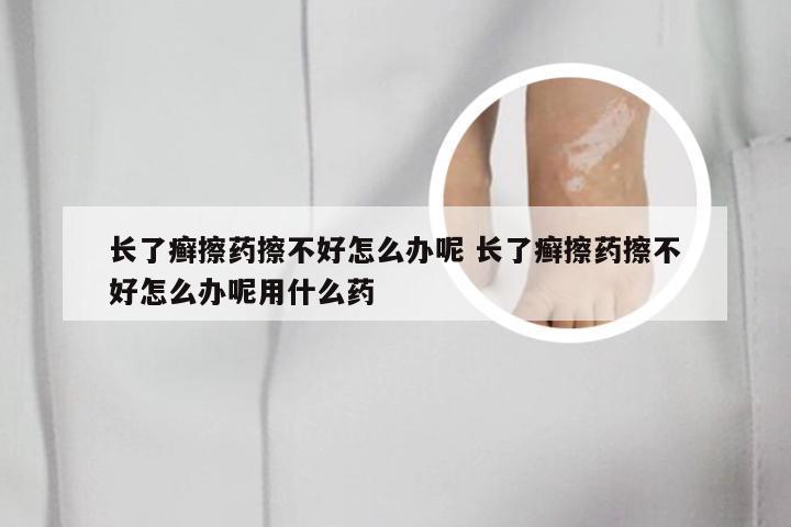 长了癣擦药擦不好怎么办呢 长了癣擦药擦不好怎么办呢用什么药