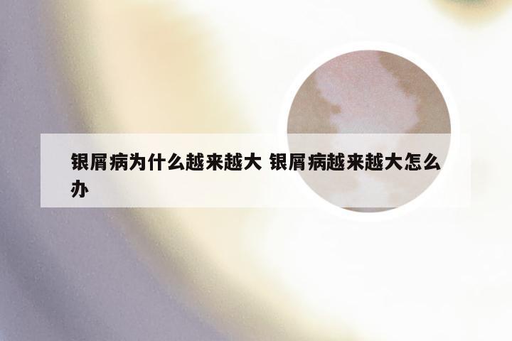 银屑病为什么越来越大 银屑病越来越大怎么办