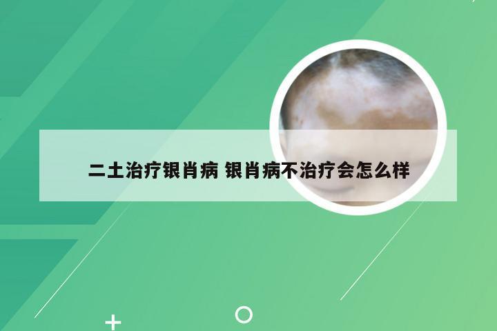 二土治疗银肖病 银肖病不治疗会怎么样