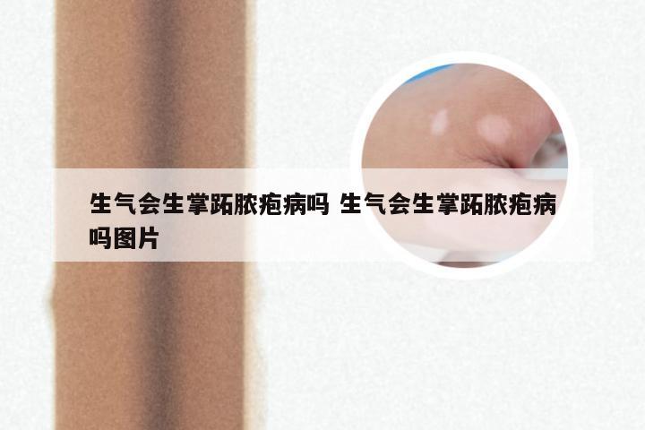 生气会生掌跖脓疱病吗 生气会生掌跖脓疱病吗图片
