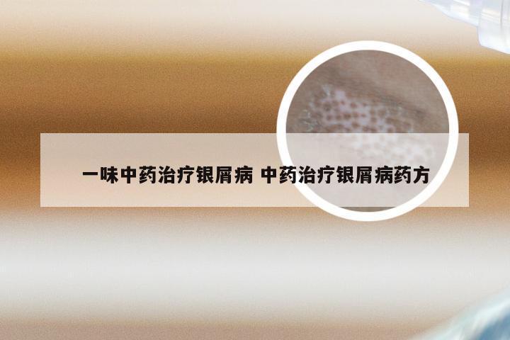一味中药治疗银屑病 中药治疗银屑病药方