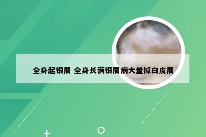全身起银屑 全身长满银屑病大量掉白皮屑