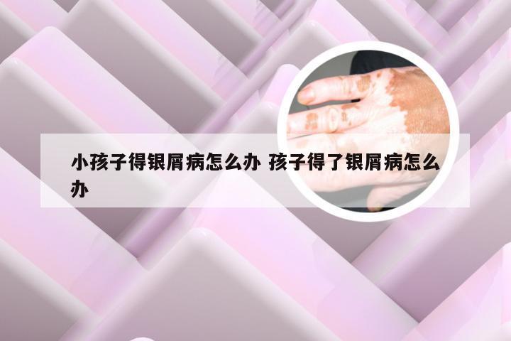 小孩子得银屑病怎么办 孩子得了银屑病怎么办