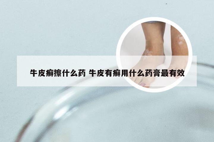 牛皮癣擦什么药 牛皮有癣用什么药膏最有效