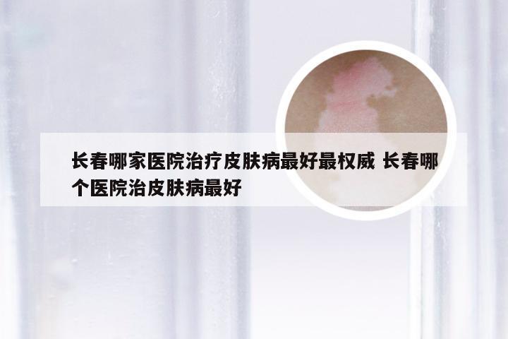 长春哪家医院治疗皮肤病最好最权威 长春哪个医院治皮肤病最好