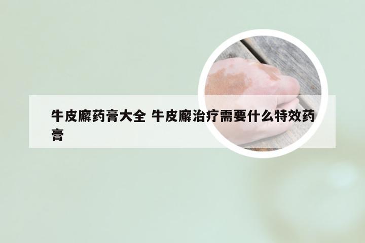 牛皮廨药膏大全 牛皮廨治疗需要什么特效药膏