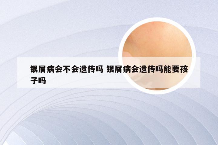 银屑病会不会遗传吗 银屑病会遗传吗能要孩子吗