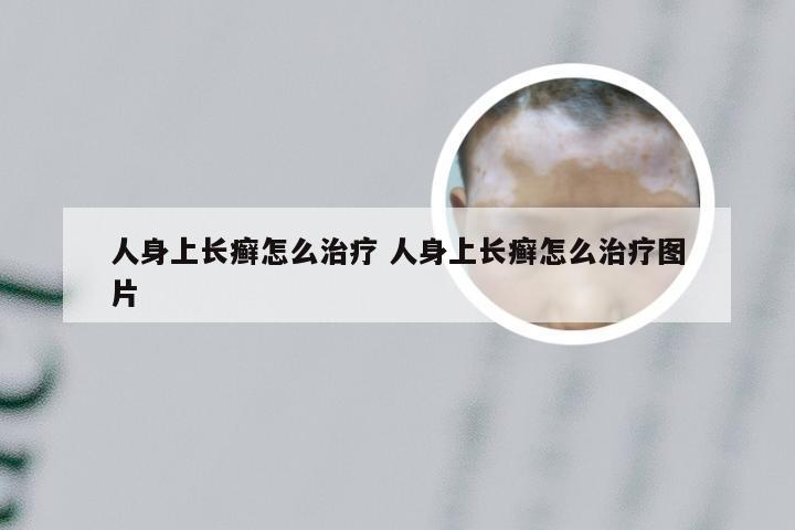 人身上长癣怎么治疗 人身上长癣怎么治疗图片