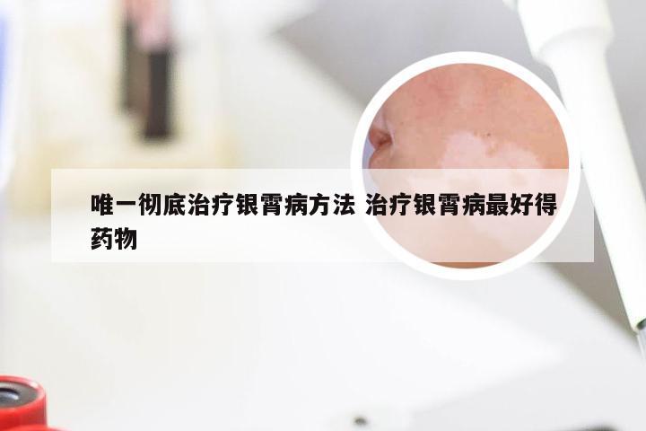 唯一彻底治疗银霄病方法 治疗银霄病最好得药物