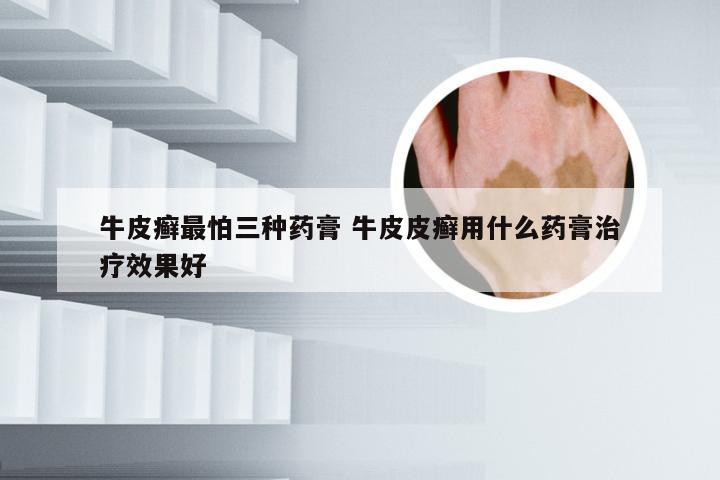 牛皮癣最怕三种药膏 牛皮皮癣用什么药膏治疗效果好
